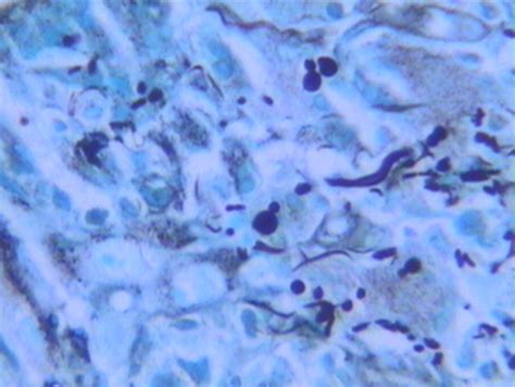 Oral Paracoccidioidomycosis And Pulmonary Tuberculosis Co Infection