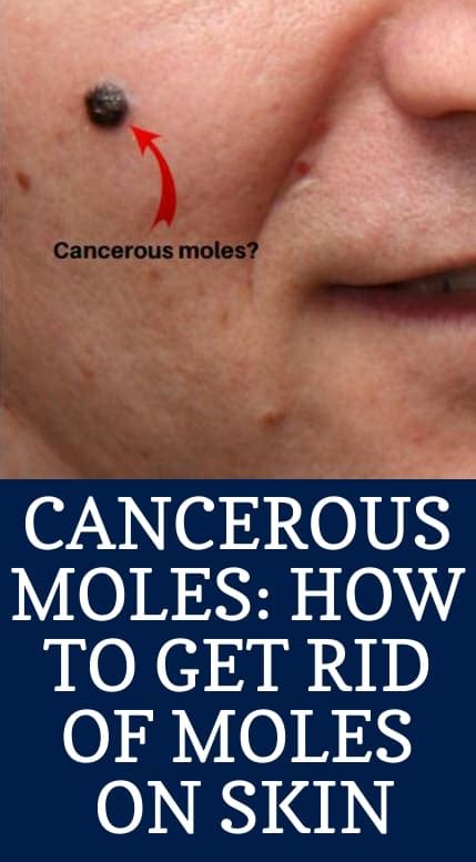 Cancerous Moles How To Get Rid Of Moles On Skin