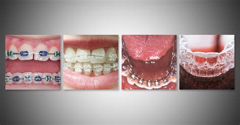 Orthodontic Appliances 101 Comparing The Most Common Types Of Braces