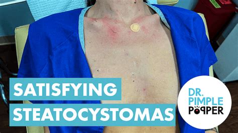 30 Minutes With A Belly Full Of Steatosystomas Steatocystoma Station