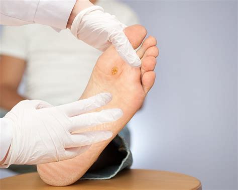 plantar warts treatment southernmost foot and ankle specialists