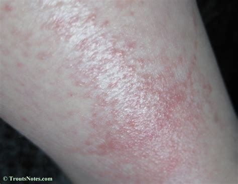 Flagellate Dermatitis From Shiitakes Trouts Notes