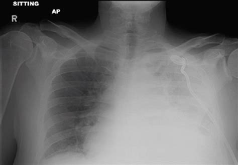 Chest X Ray Showing Increased Opacification Of Left Hemithorax