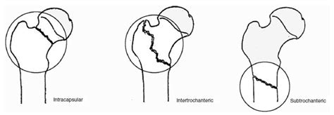 Hip Fractures Classification Neurorehabwiki