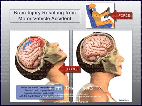 Brain Injury Resulting From Motor Vehicle Accident Trialexhibits Inc