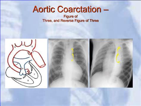Ppt Chest X Ray Signs Of Cardiac Disease Powerpoint Presentation