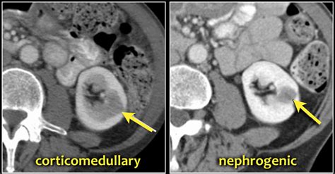 The Radiology Assistant Kidney Solid Masses