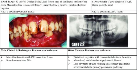A Sample Case Of Stage Iii Aggressive Periodontitis Listed In The Case