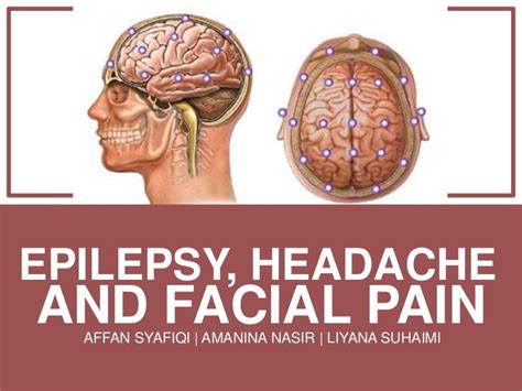 Epilepsy Headache And Facial Pain