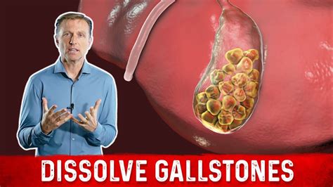 What Causes Gallstones And How To Treat Them Dr Berg