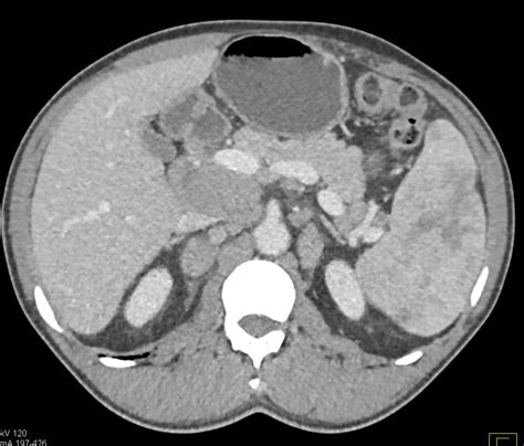Lymphoma Infiltrates The Head Of The Pancreas And Adrenal Glands And