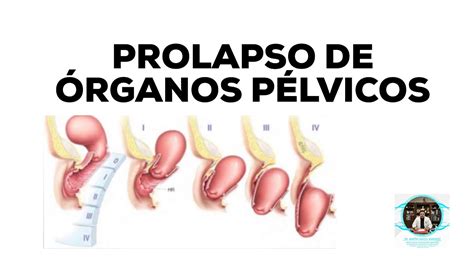 Prolapso De Organos Pelvicos YouTube