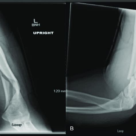 Immediate Postoperative Anteroposterior A And Lateral B Radiographs