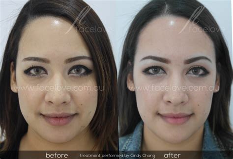 Facial Reshaping And Facial Slimming Facelove St Kilda Melbourne