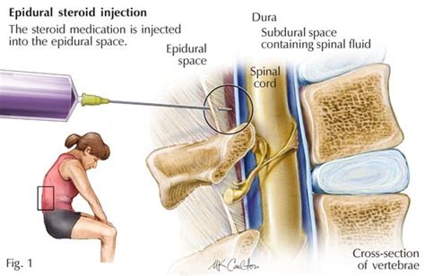 Epidural Steroid Injection For Back Pain Best Pain Doctor Nyc