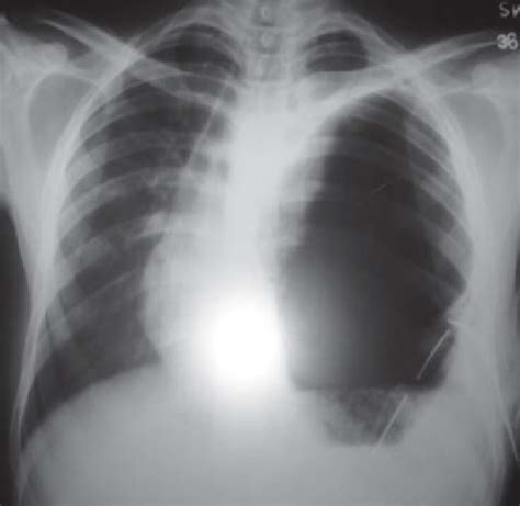 Chest Radiograph Postero Anterior View Showing Kinked Intercostal