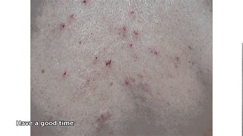 An itch most common cause, is dehydration of the skin. itchy skin rash - YouTube