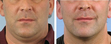 Thermage For Non Surgical Face Lifts And To Tighten Loose Skin Was The