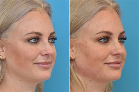 Injectable Fillers Photos Philadelphia Pa Patient 1553
