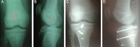 Radiographies In Ap And Profile Of The Right Knee Showing Att