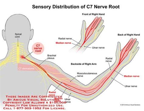 C7 8 Nerve Root Compression