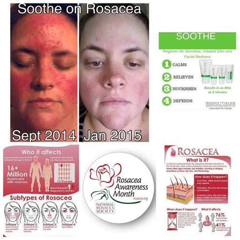 Rosacea Awareness Month Is April Message Me To Find Out How Rodan
