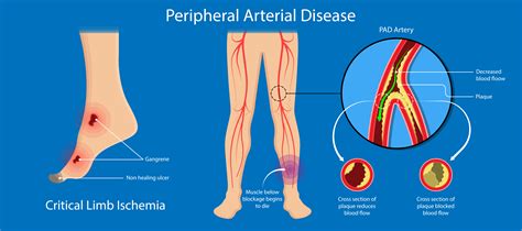 Peripheral Artery Disease Wockhardthospitals