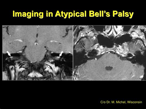 Ppt Imaging In Acute Facial Nerve Paralysis Powerpoint Presentation