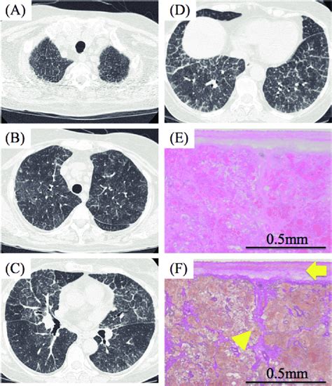 Representative Images Of Chest High Resolution Computed Tomography And