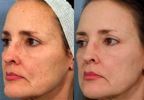 Ipl Intense Pulsed Light Lowe Dermatology Anti Aging Solutions