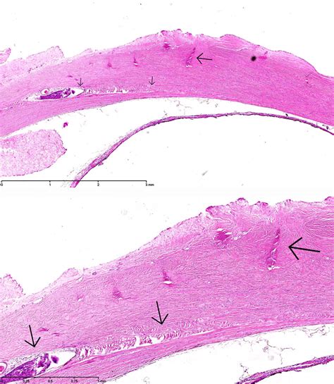 Histopathology Of The Enucleated Eye Of Case 6 The Layers Of The