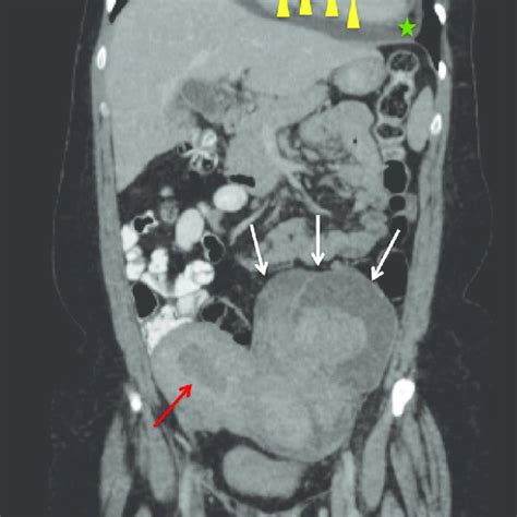 Axial Image Of A Contrast Enhanced Abdomen And Pelvis Ct Scan At The