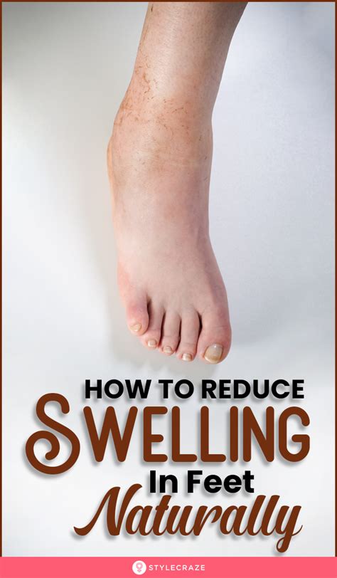 16 Effective Home Remedies For Swollen Feet In 2020 With Images Home Remedies Remedies How