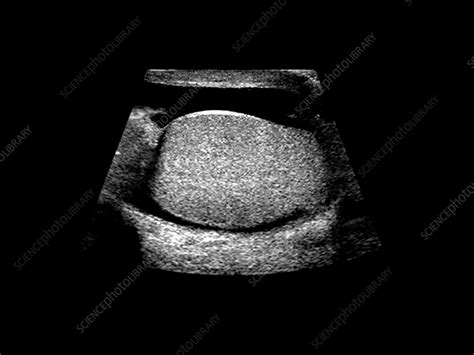 Ultrasound Of Normal Testicle Stock Image P6800717 Science Photo Library