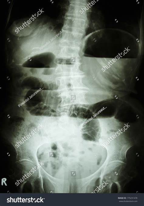 Film X Ray Abdomen Upright Show Small Bowel Dilated And Air Fluid Level