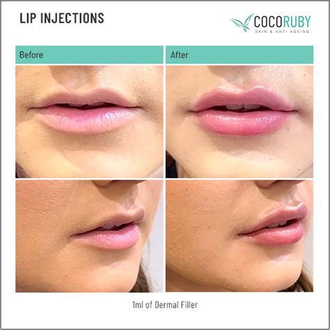 Lip Filler Before And After Photos Coco Ruby Skin