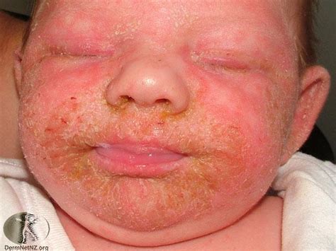 Seborrheic Dermatitis In Children Tendig