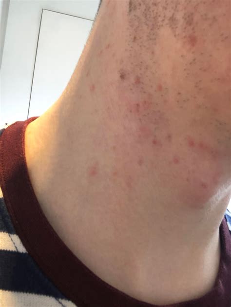 Acne I Have These Red Marks On My Neck That Fluctuate In Redness