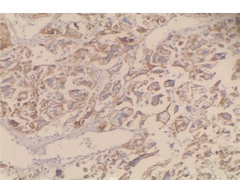 Figure 1 From Pleomorphic Giant Cell Adeno Carcinoma Gall Bladder A