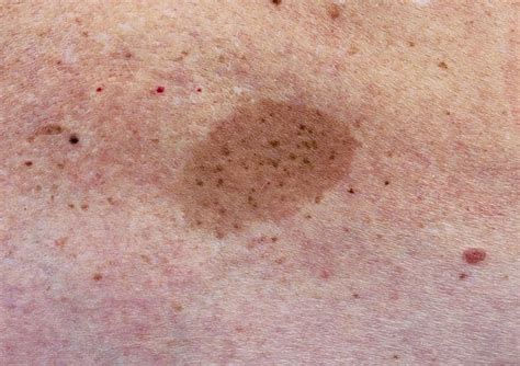 Brown Spots On Skin Causes