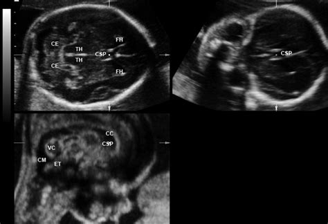 Ultrasound Images Fetal Heart Ultrasound Images