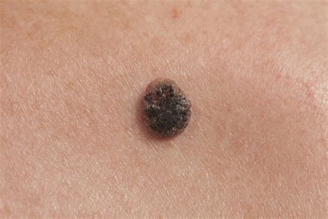 Cancerous Moles What Do They Look Like
