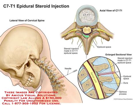 Amicus Illustration Of Amicusinjectionepiduralc7 T1cervicalspine