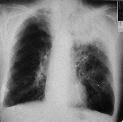 Chest Radiograph Showing Extensive Inflammatory Changes Involving The