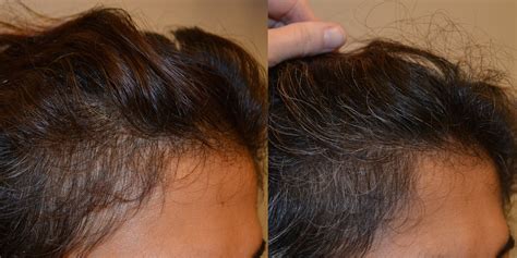 Platelet Rich Plasma Prp Before And After Photos Hair Restoration Of