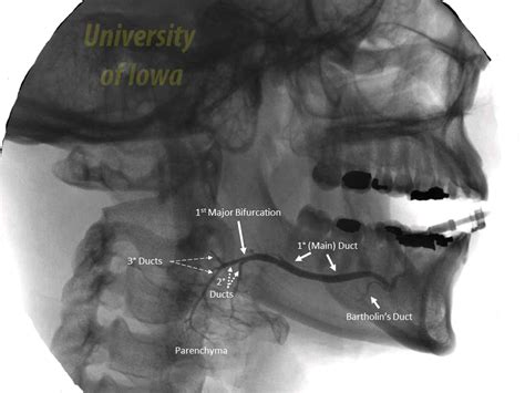 Classification Of Salivary Duct Stenosis Parotid Duct Stricture