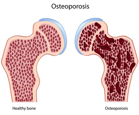 Лечение остеопороза в Израиле цены отзывы стоимость Остеопороз