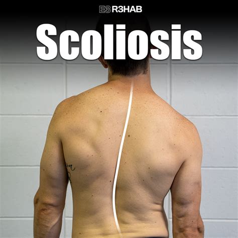 Scoliosis E3 Rehab
