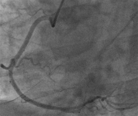 Figure 3 A Case Of Acute Myocardial Infarction With ST Segment