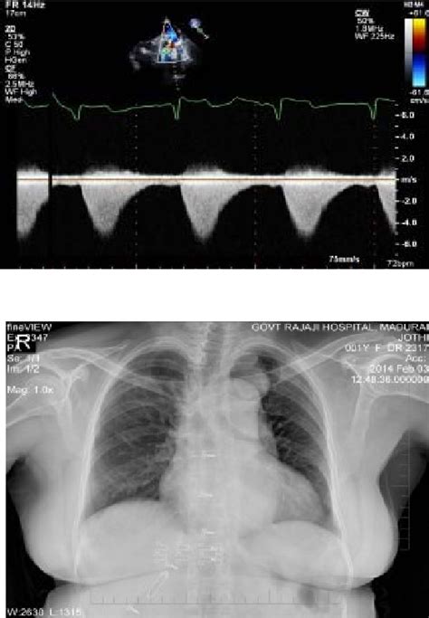 Figure From Coarctation Of Aorta With Aberrant Right Subclavian